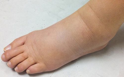 Cây thóc lép có thể chữa rất nhiều bệnh như phù nề, tích nước bên trong cơ thể