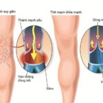 Ứng dụng đông y chữa suy giãn tĩnh mạch chân