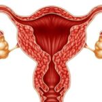 Cách chữa buồng trứng đa nang theo góc nhìn Đông y