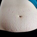 Trị rạn da sau sinh với Đông Y