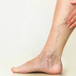 Hiệu quả của bấm huyệt chữa suy giãn tĩnh mạch