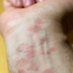 Có thể chữa Eczema bằng đông y?