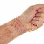 Có thể dùng đông y chữa xuất huyết giảm tiểu cầu?