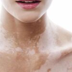 Các cây thuốc nam trị bệnh bạch biến
