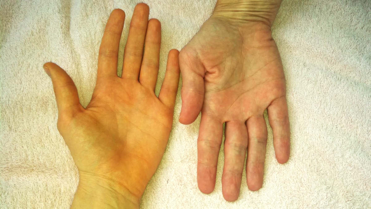 Vàng da - Dấu hiệu của bệnh gan