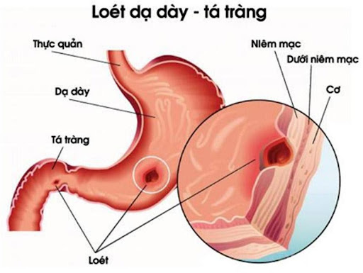 Lô hội trị loét dạ dày, tá tràng