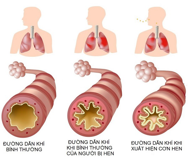 cáp giới chữa hen phế quản