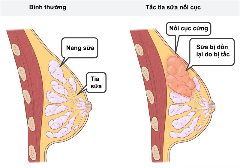 Thông thảo: Vị thuốc thông sữa, lợi niệu 6.jpg