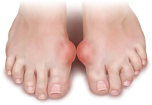 cây trứng cá trị bệnh gout